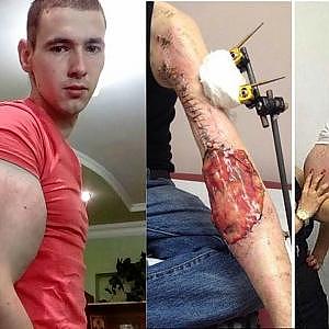 Synthol Kid gets his arms drained